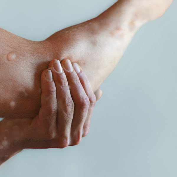 Male arm affected by blistering rash because of monkeypox or other viral infection on grey